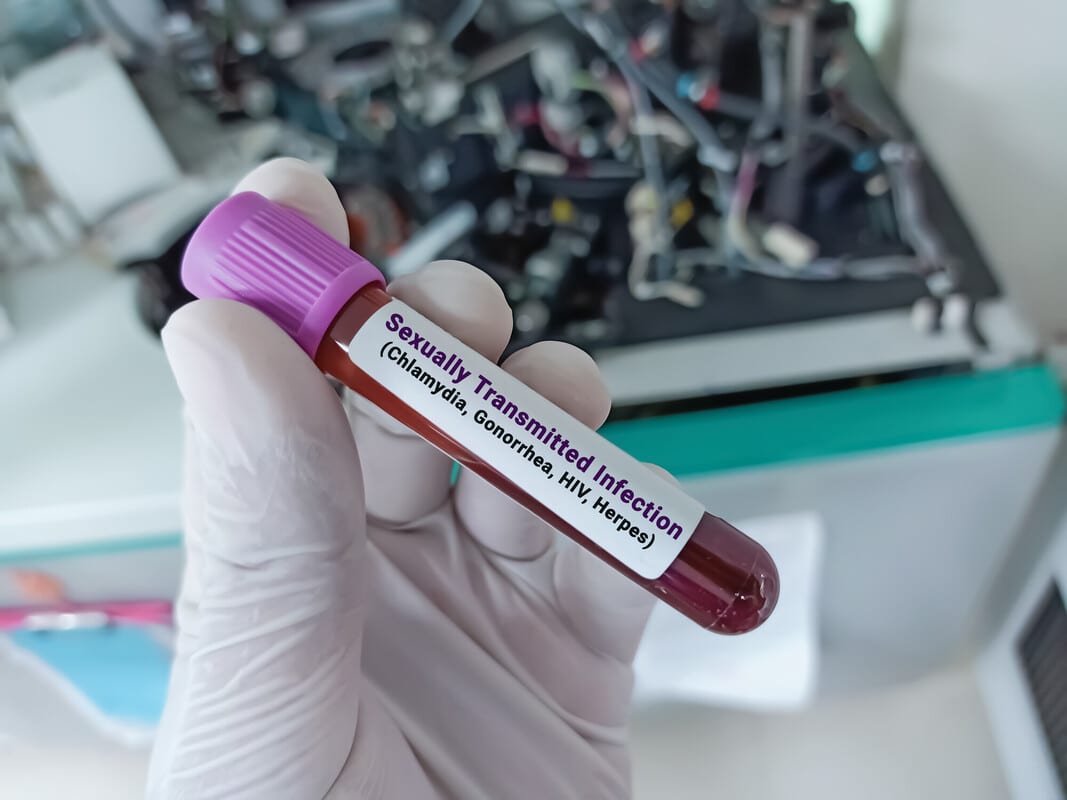 Check up malattie sessualmente trasmesse